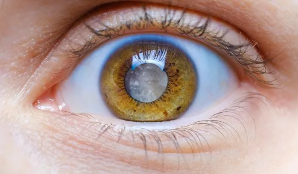 Cataracts