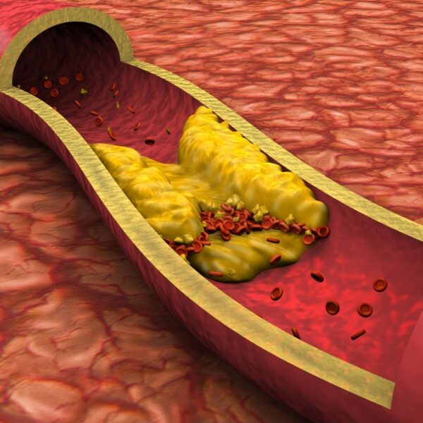 Cholesterol