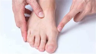 Bunion