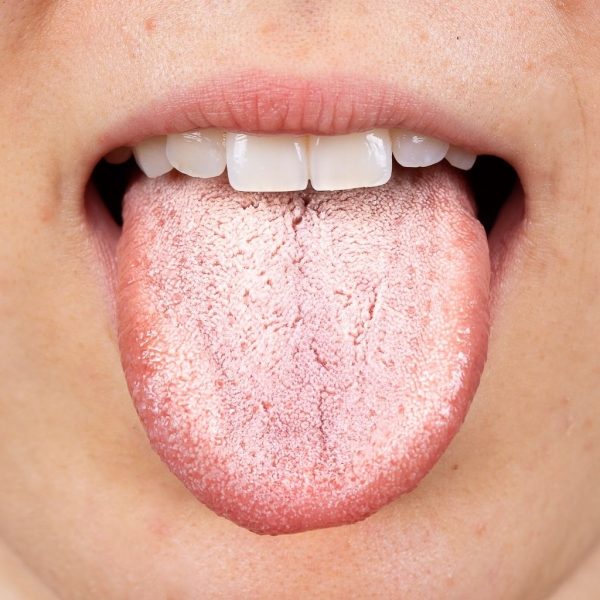 Candida